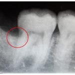 【症例】歯肉縁下（歯茎より下部分）の虫歯の処置と再生治療の併用