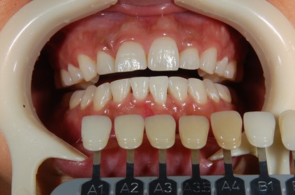 【症例】ティオンのホワイトニングで美しく白い歯に（30代女性）｜恵比寿の歯医者 恵比寿デンタルクリニック東京の症例｜ホワイトニング2回終了時歯の色を確認している画像