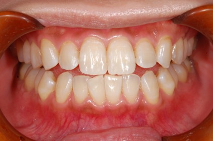 【症例】少し暗めの歯の色をホワイトニングで明るく（20代女性）｜恵比寿デンタルクリニック東京｜ホワイトニング後の写真